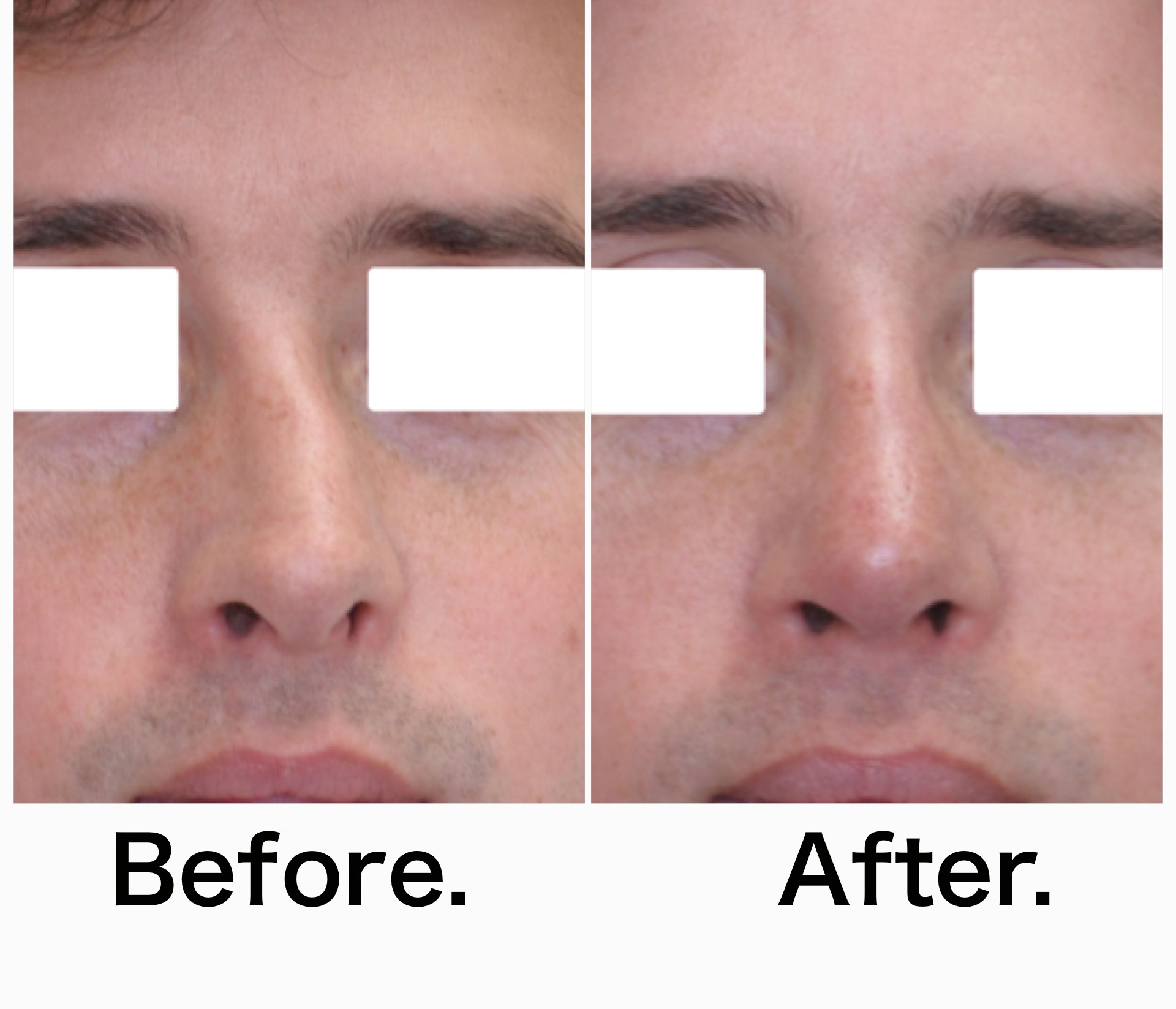 Rhinoplasty surgery before and after #7