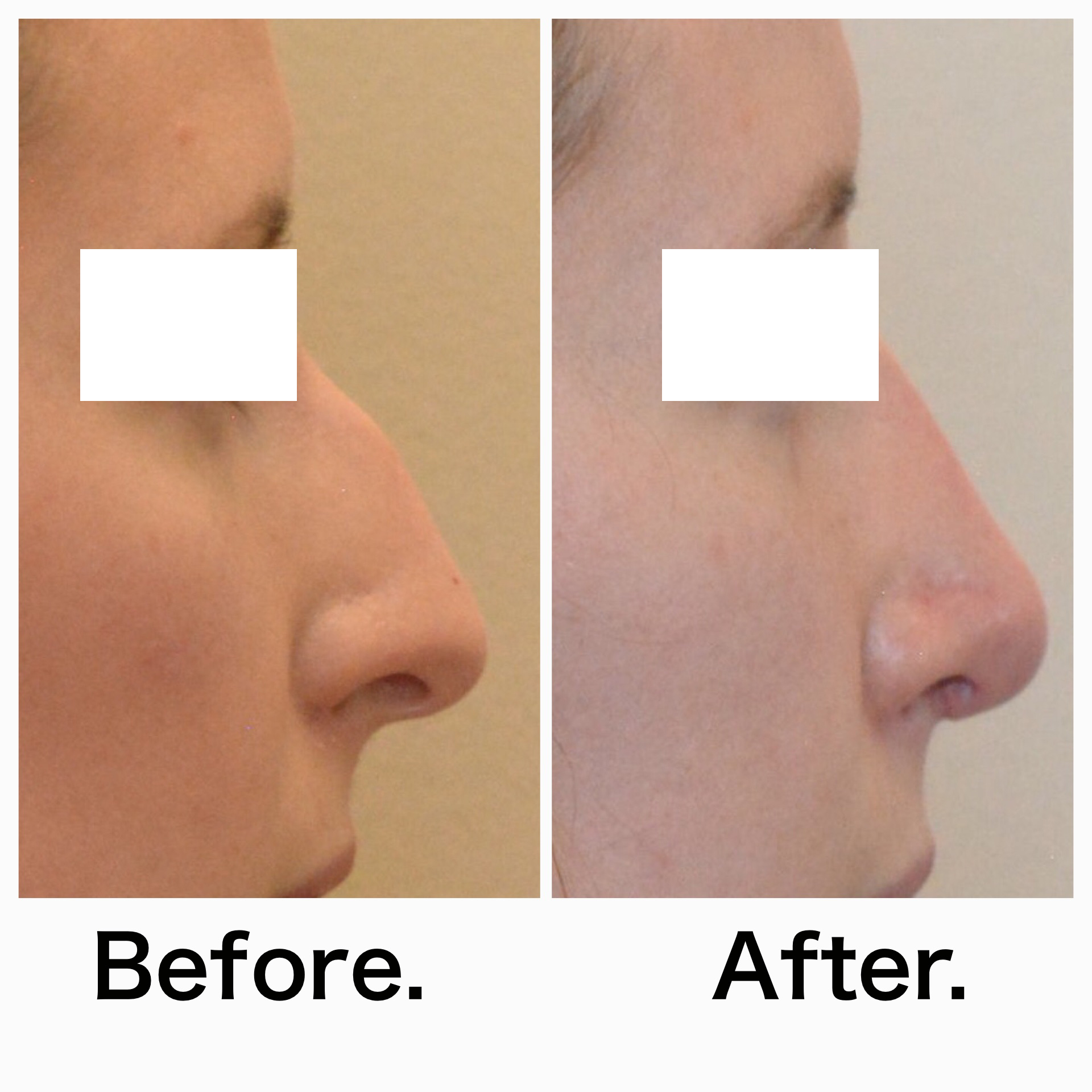 Rhinoplasty surgery before and after #8