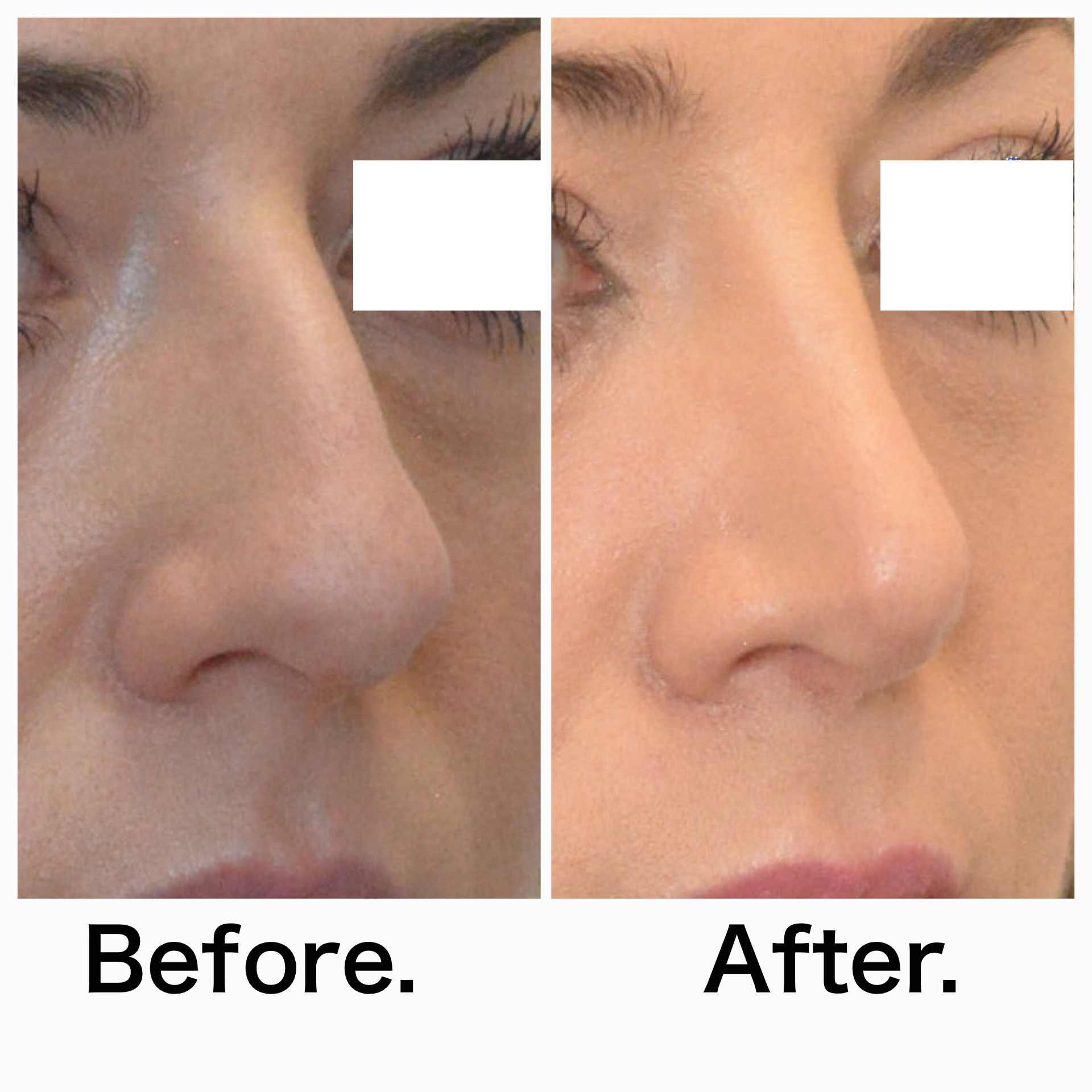 Rhinoplasty surgery before and after #10