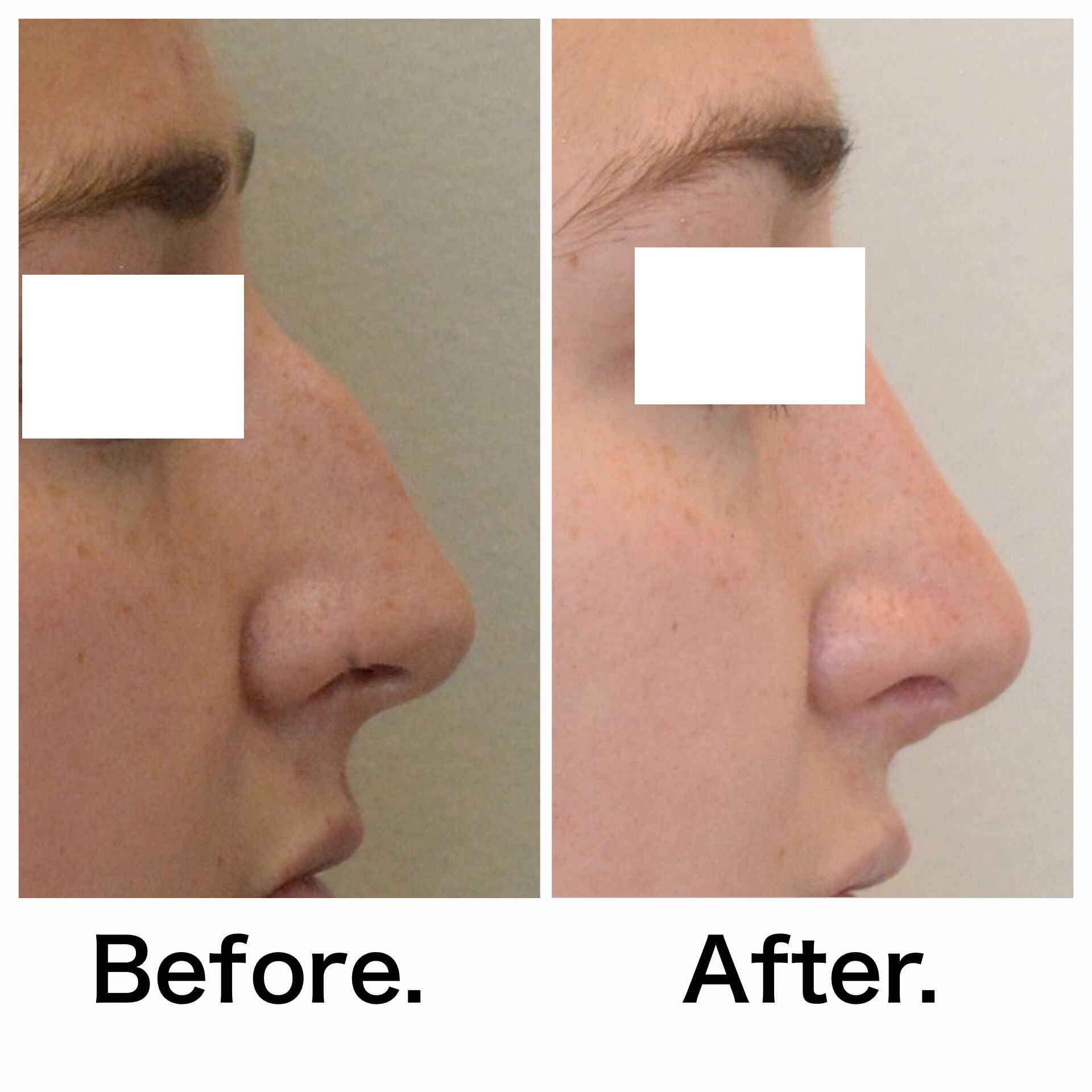 Rhinoplasty surgery before and after #14