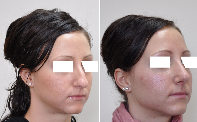 Rhinoplasty surgery before and after #2